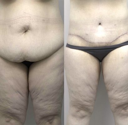 Abdominoplasty_1_BA