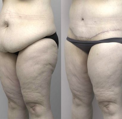 Abdominoplasty_2_BA