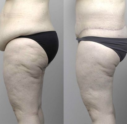 Abdominoplasty_3_BA