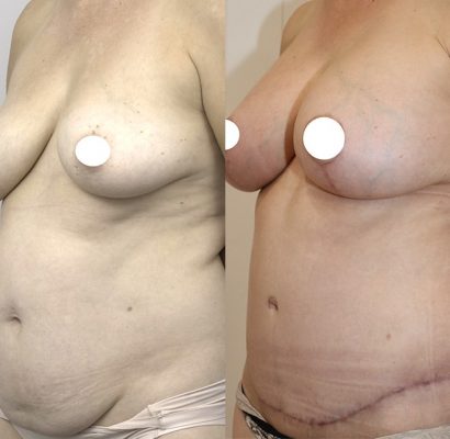 Abdominoplasty_4_BA