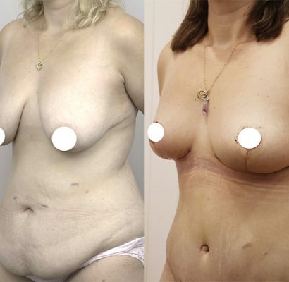 Abdominoplasty_5_BA