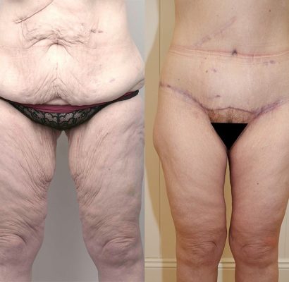 Abdominoplasty_6_BA