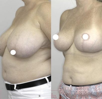 Breast_Reduction_2_BA-1